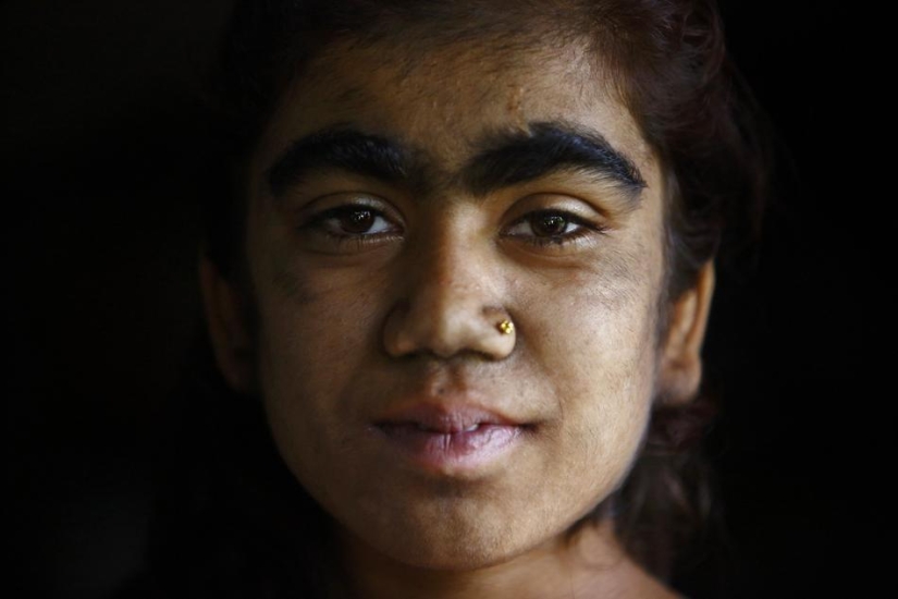 Wolf people, victims of hypertrichosis, underwent laser hair removal