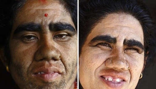 Wolf people, victims of hypertrichosis, underwent laser hair removal