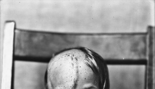 11 Haunting Medical Portraits Of Harvey Cushing’s Patients In The Early 20th Century 11 Haunting Medical Portraits Of Harvey Cushing’s Patients In The Early 20th Century