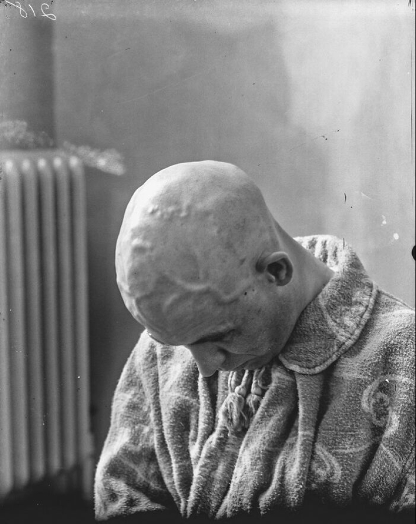 11 inquietantes retratos médicos de los pacientes de Harvey Cushing a principios del siglo XX