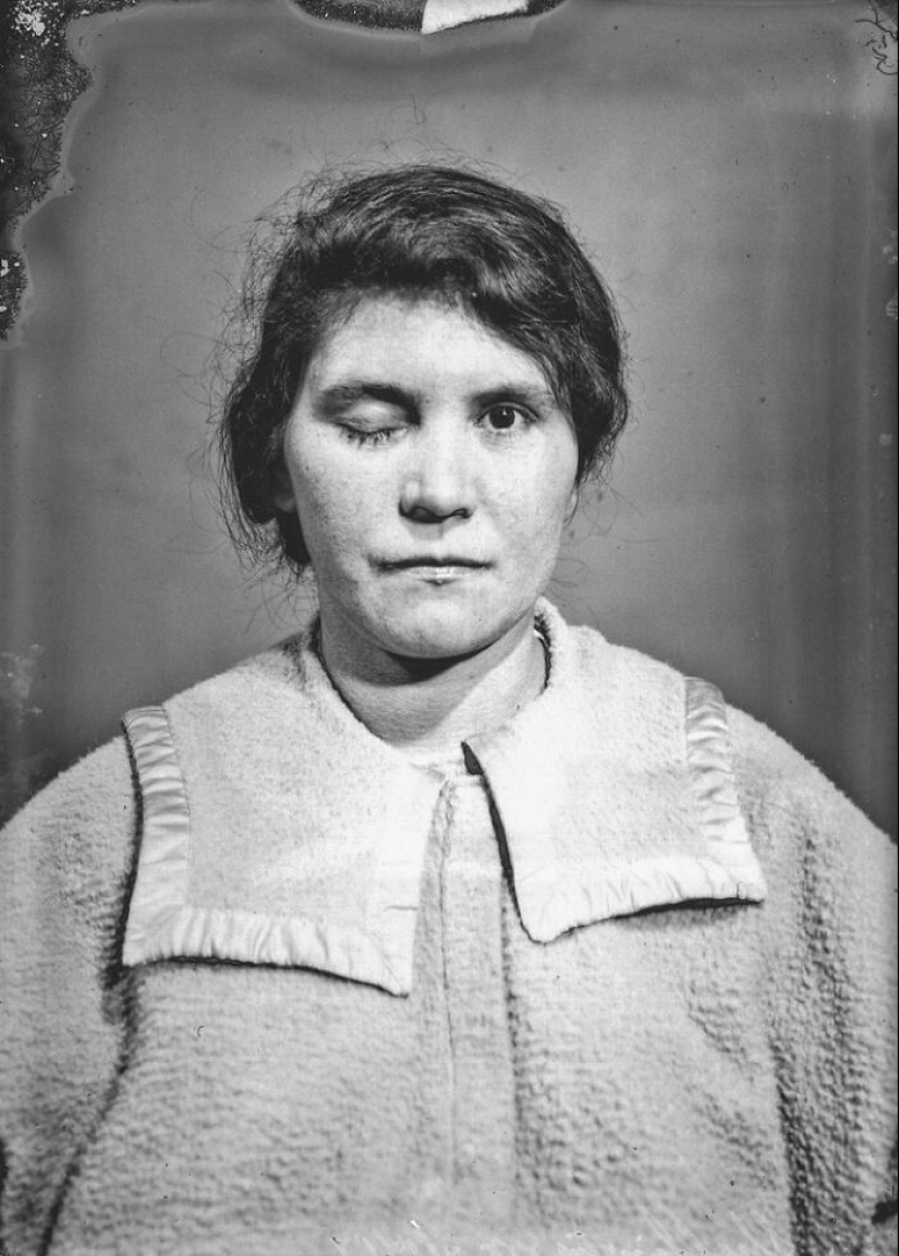 11 inquietantes retratos médicos de los pacientes de Harvey Cushing a principios del siglo XX