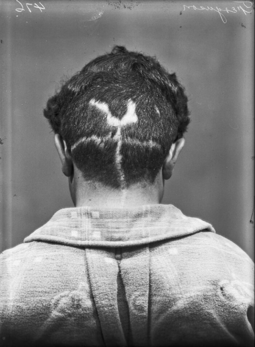 11 inquietantes retratos médicos de los pacientes de Harvey Cushing a principios del siglo XX