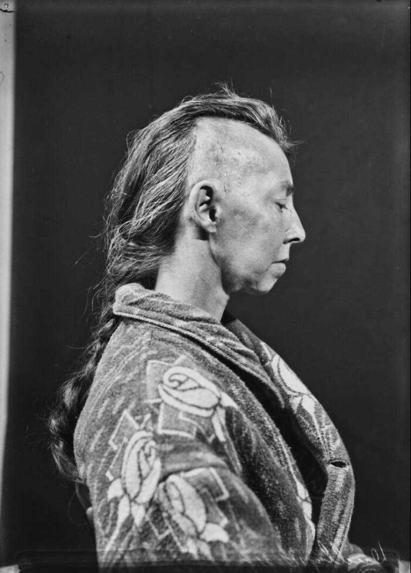 11 inquietantes retratos médicos de los pacientes de Harvey Cushing a principios del siglo XX