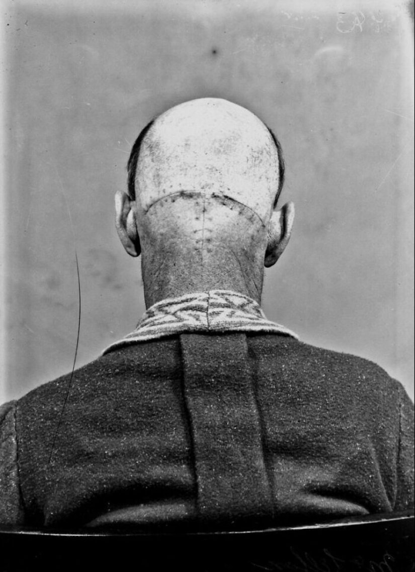 11 inquietantes retratos médicos de los pacientes de Harvey Cushing a principios del siglo XX