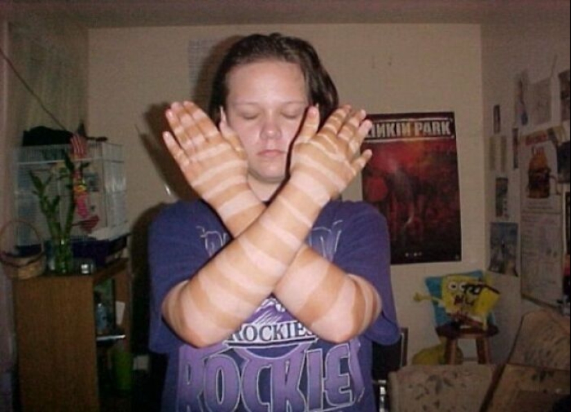 15 People Who Thought They Didn’t Need Sunscreen And Ended Up Looking Like Dorks