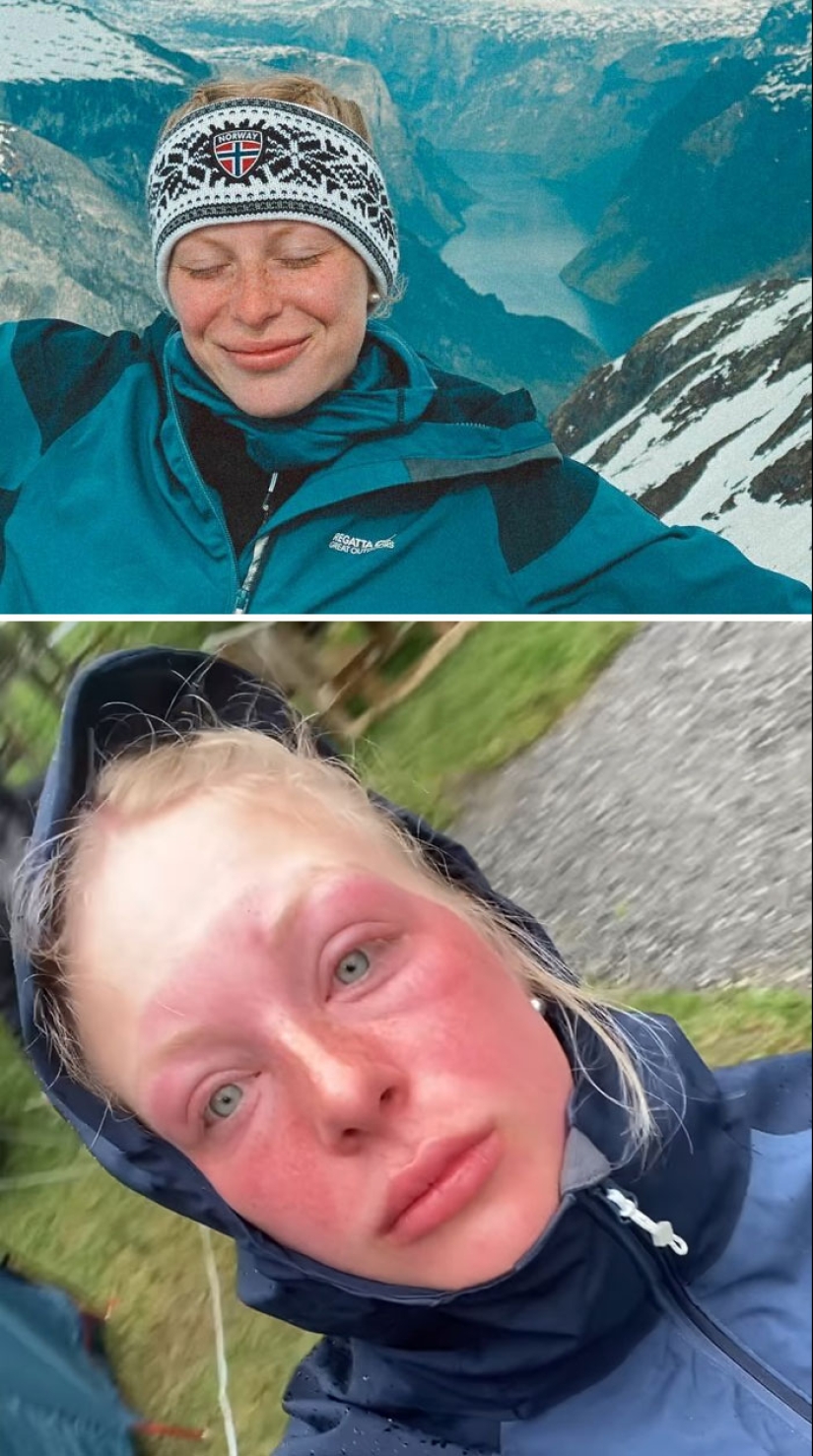 15 People Who Thought They Didn’t Need Sunscreen And Ended Up Looking Like Dorks