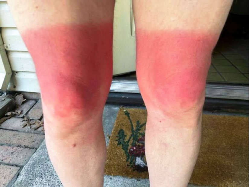 15 People Who Thought They Didn’t Need Sunscreen And Ended Up Looking Like Dorks
