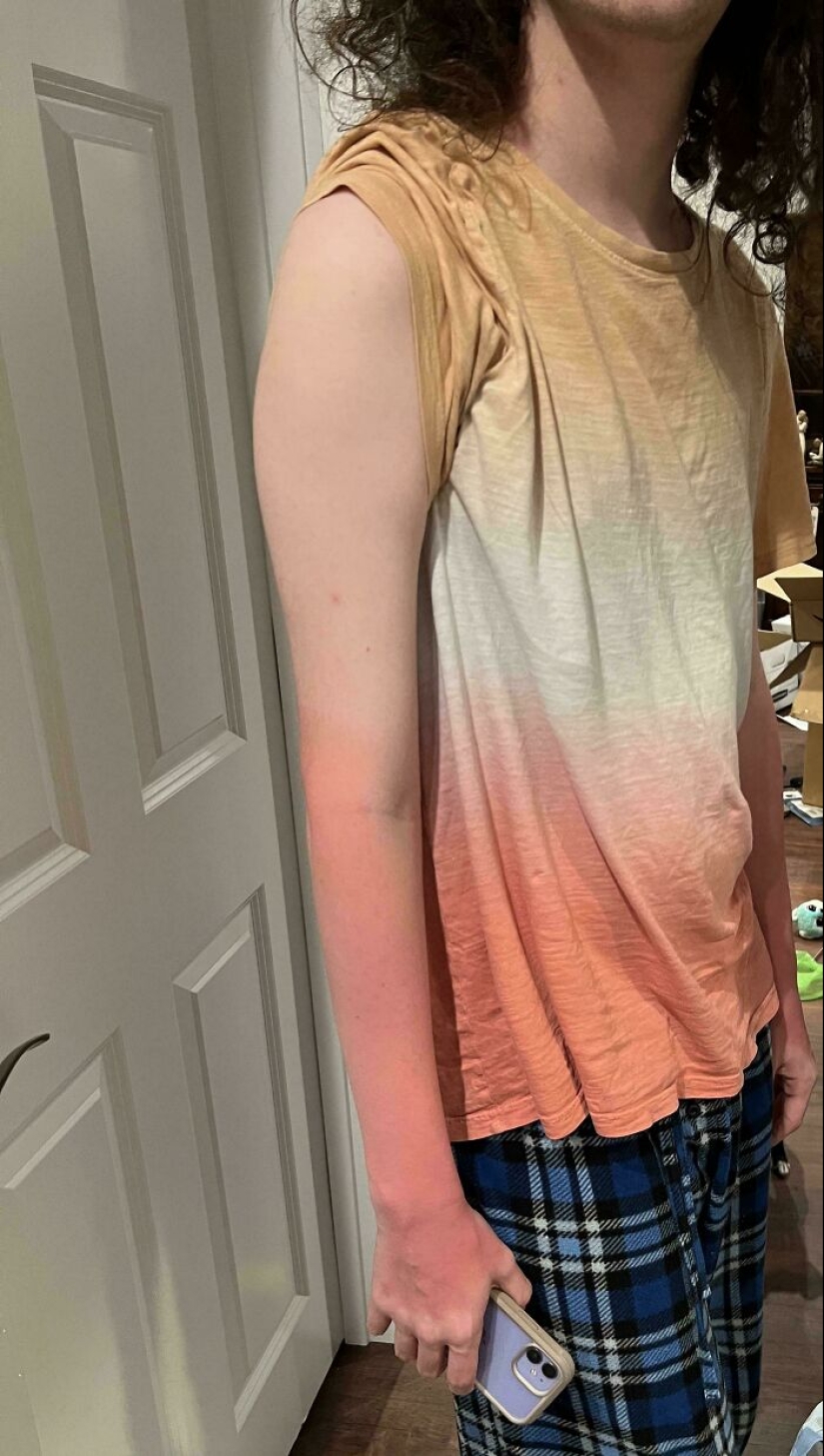 15 People Who Thought They Didn’t Need Sunscreen And Ended Up Looking Like Dorks