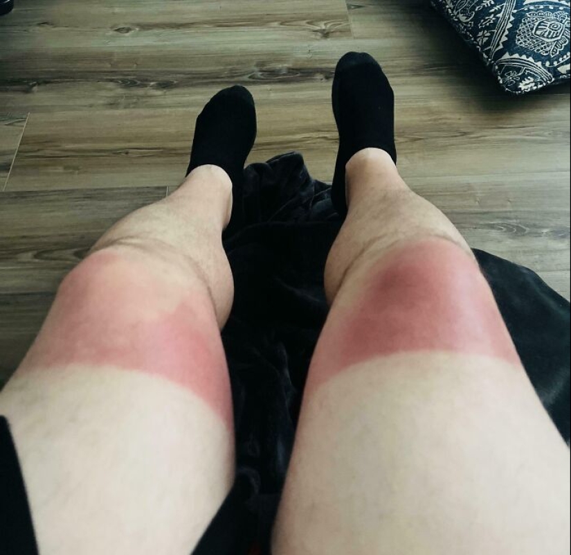 15 People Who Thought They Didn’t Need Sunscreen And Ended Up Looking Like Dorks
