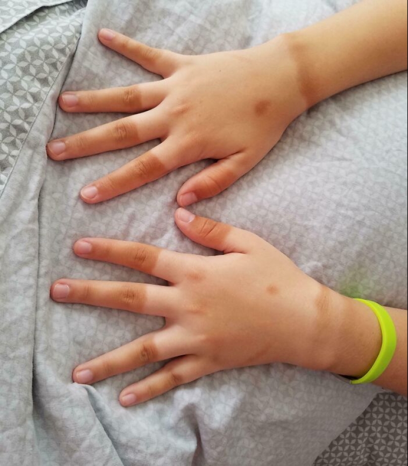 15 People Who Thought They Didn’t Need Sunscreen And Ended Up Looking Like Dorks