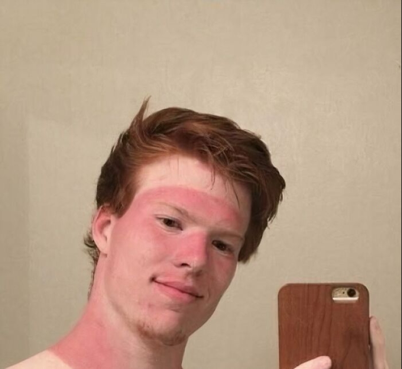15 People Who Thought They Didn’t Need Sunscreen And Ended Up Looking Like Dorks