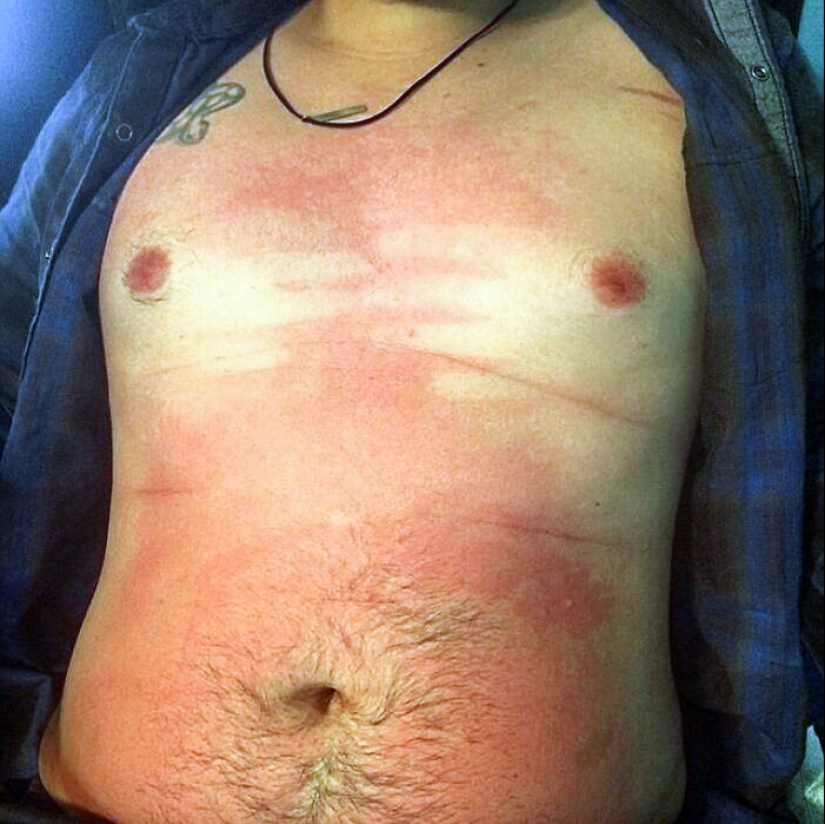 15 People Who Thought They Didn’t Need Sunscreen And Ended Up Looking Like Dorks