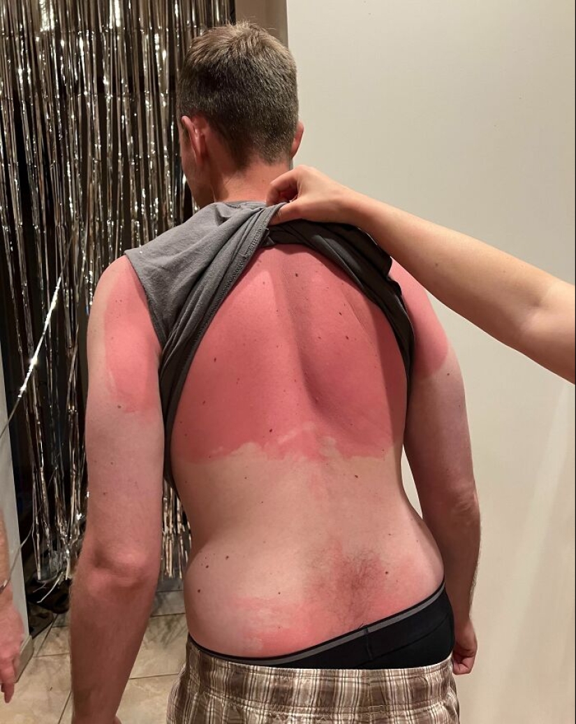 15 People Who Thought They Didn’t Need Sunscreen And Ended Up Looking Like Dorks