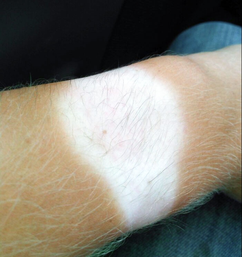 15 People Who Thought They Didn’t Need Sunscreen And Ended Up Looking Like Dorks