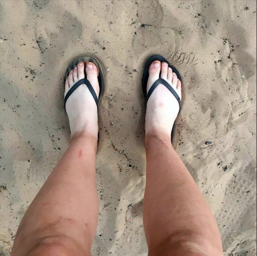 15 People Who Thought They Didn’t Need Sunscreen And Ended Up Looking Like Dorks