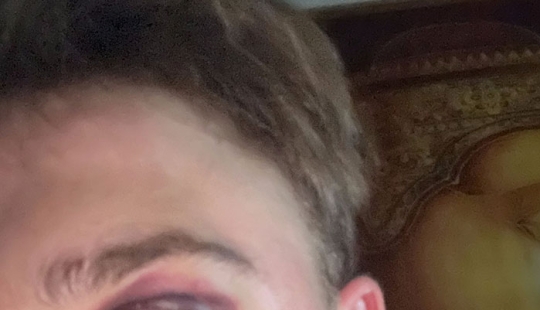 29-Year-Old Trans Man Gets Brutally Beaten Up In Switzerland, Claims It’s A Hate Crime 29-Year-Old Trans Man Gets Brutally Beaten Up In Switzerland, Claims It’s A Hate Crime