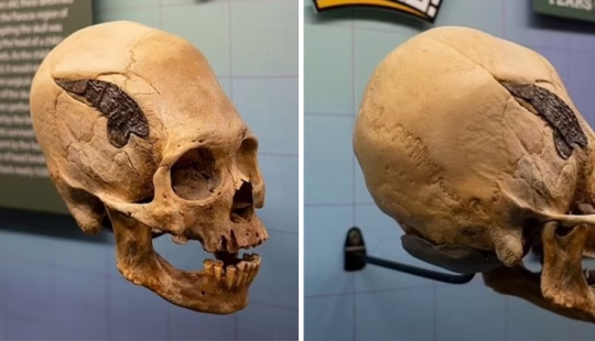 A human skull bonded with metal 2000 years ago amazed scientists