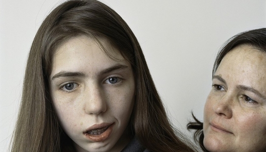 About Face: photo portraits of people suffering from paralysis