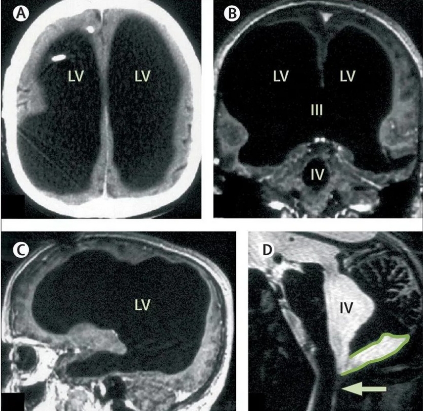 El hombre vivió sin cerebro hasta los 44 años y no se dio cuenta