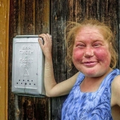 Gastronomy tan, or How to recognize an alcoholic in appearance