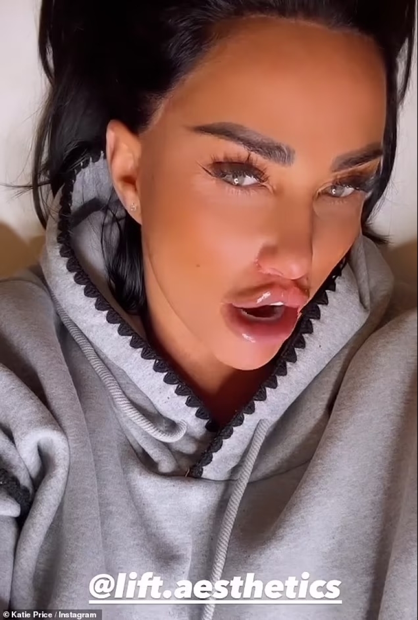 Katie Price shocks as she reveals the results of her 'bum lift' in TINY black thong