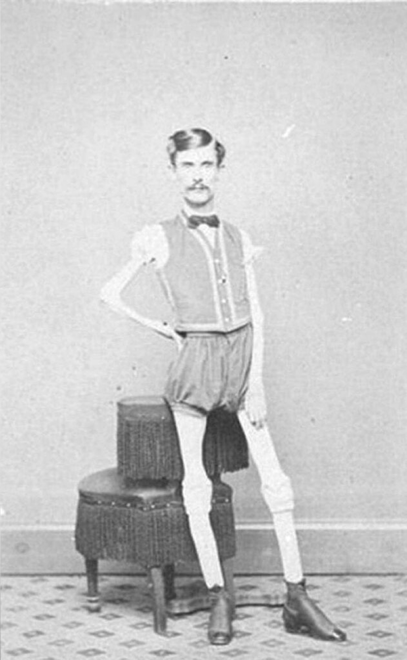 La trágica historia del "esqueleto viviente" Isaac Sprague