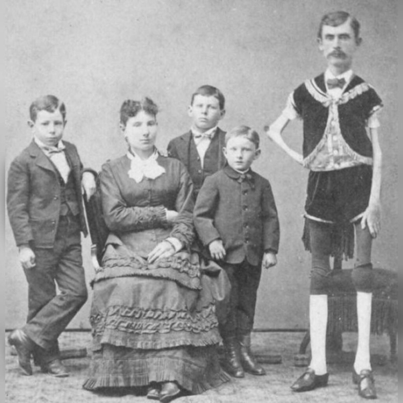 La trágica historia del "esqueleto viviente" Isaac Sprague