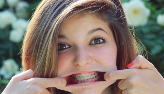 Monobrow, braces and 8 more appearance flaws that are considered attractive by other peoples