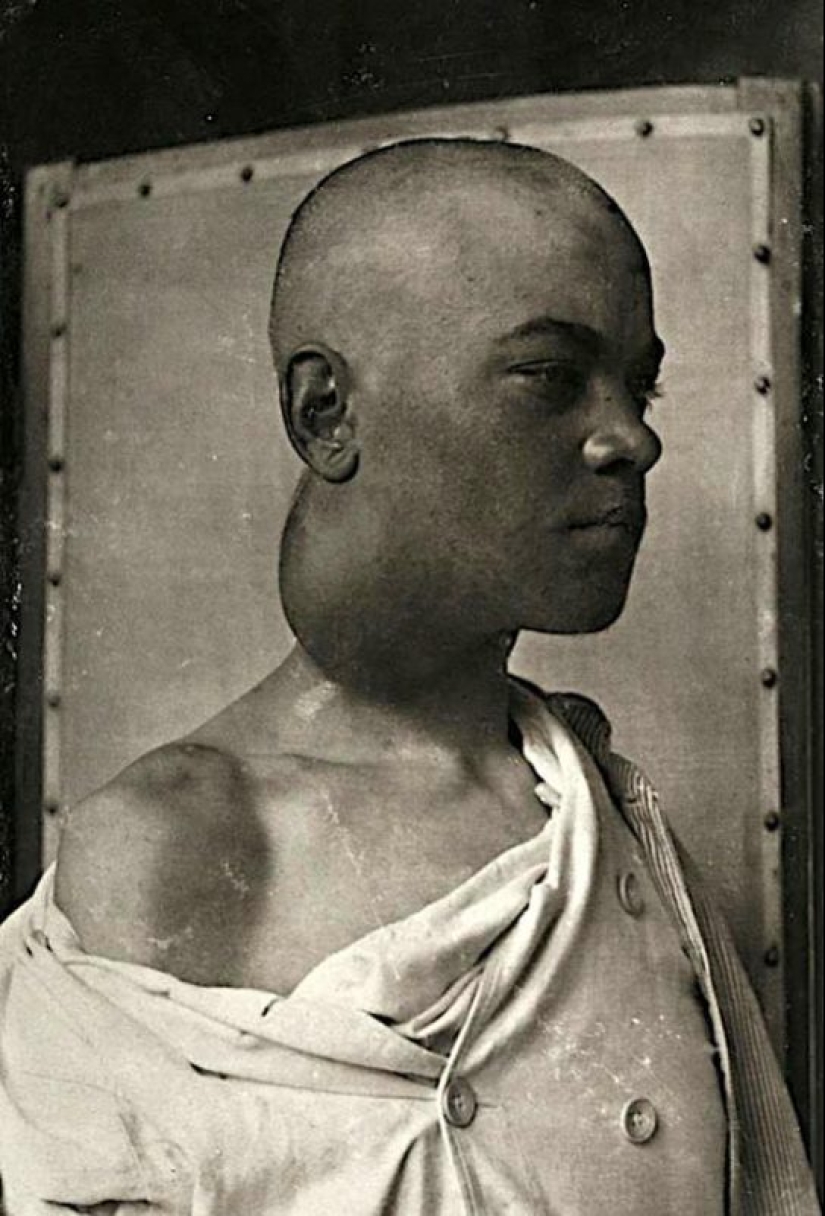 Portraits of pain: striking photographs of patients from nineteenth-century suffering from serious illnesses