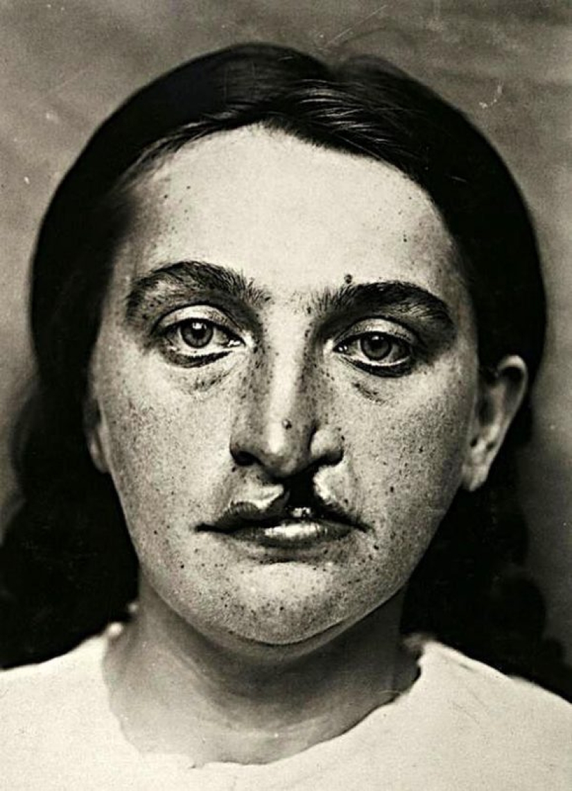 Portraits of pain: striking photographs of patients from nineteenth-century suffering from serious illnesses