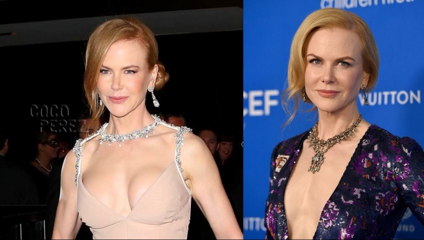 See above: Stars who have had breast reduction surgery See above: Stars who have had breast reduction surgery