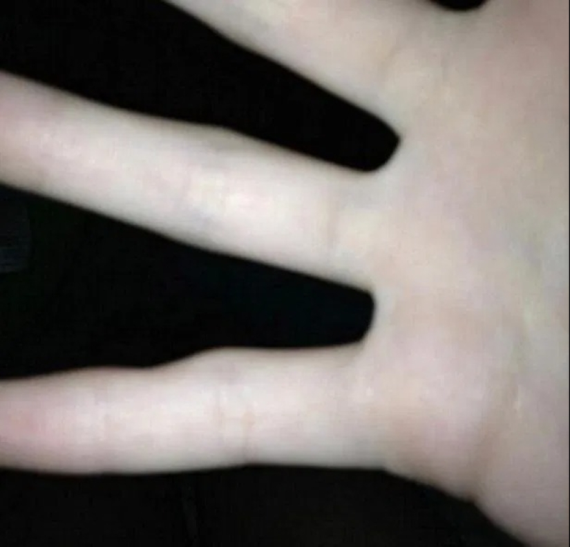 Smart Pinky: los usuarios de teléfonos inteligentes están experimentando cada vez más deformidad en los dedos Smart Pinky: los usuarios de teléfonos inteligentes están experimentando cada vez más deformidad en los dedos