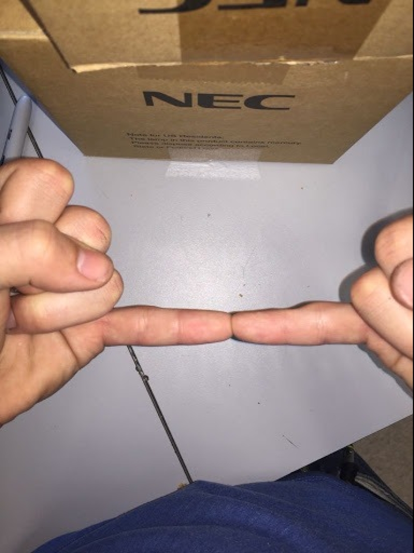 Smart Pinky: smartphone users are increasingly experiencing finger deformity