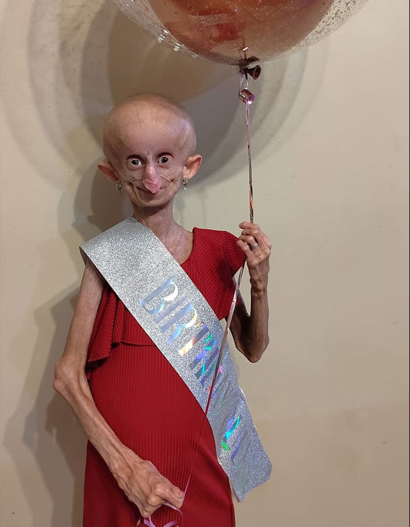 Teen Who Aged 8 Times Faster And Dreamed Of Marrying Passes Away Before Christmas Teen Who Aged 8 Times Faster And Dreamed Of Marrying Passes Away Before Christmas