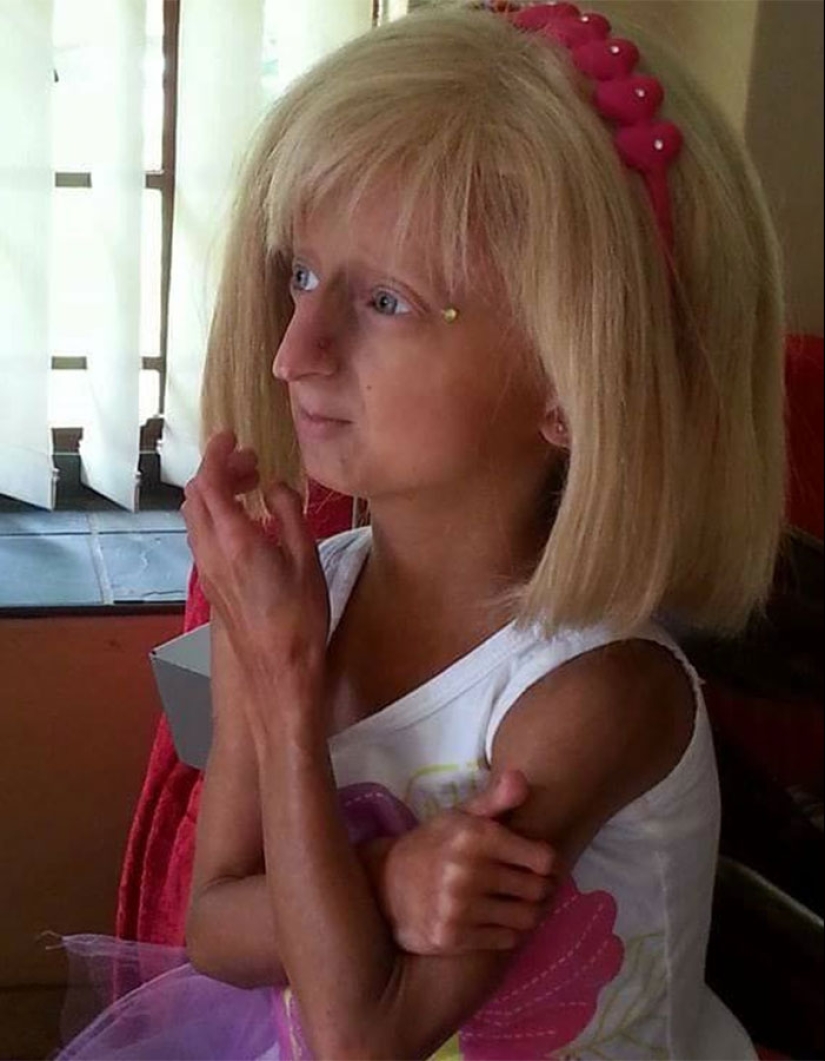 Teen Who Aged 8 Times Faster And Dreamed Of Marrying Passes Away Before Christmas Teen Who Aged 8 Times Faster And Dreamed Of Marrying Passes Away Before Christmas