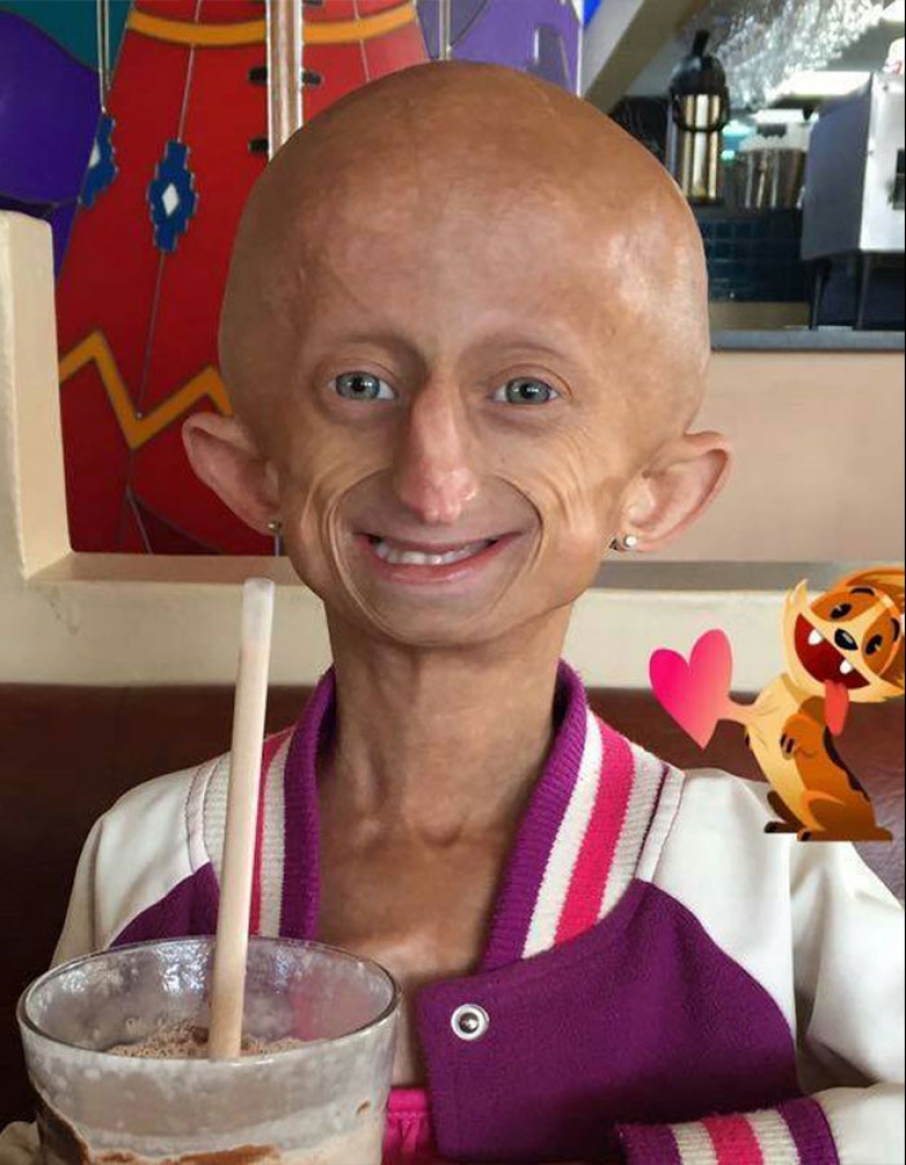 Teen Who Aged 8 Times Faster And Dreamed Of Marrying Passes Away Before Christmas Teen Who Aged 8 Times Faster And Dreamed Of Marrying Passes Away Before Christmas