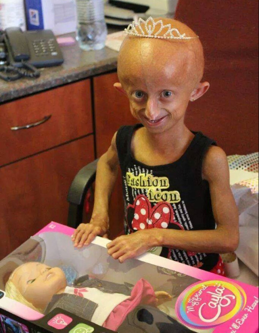 Teen Who Aged 8 Times Faster And Dreamed Of Marrying Passes Away Before Christmas Teen Who Aged 8 Times Faster And Dreamed Of Marrying Passes Away Before Christmas