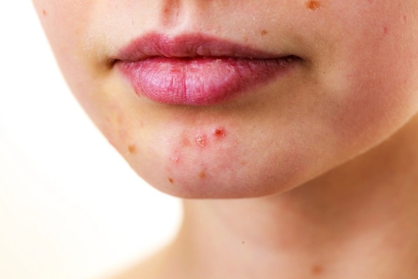 Winter, cold, cracked lip: 8 tips for skin care in the cold season Winter, cold, cracked lip: 8 tips for skin care in the cold season