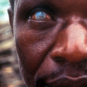 10 of the most dangerous parasites that can live in the human body