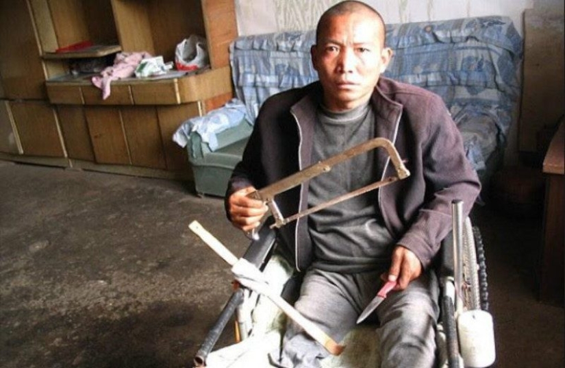 10 situaciones extremas en las que una extremidad tuvo que ser amputada independientemente para sobrevivir