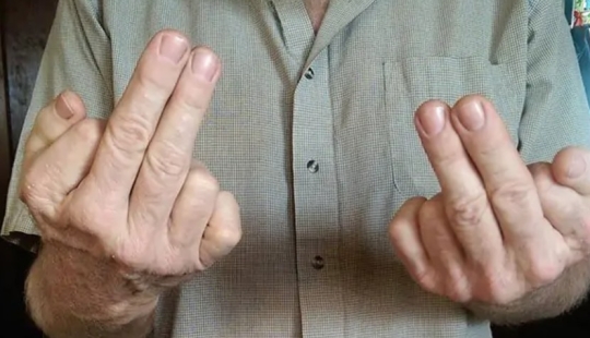 17 rare anomalies of human hands