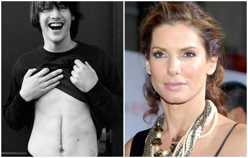 20 historias de la aparición de cicatrices en estrellas rusas y extranjeras 20 historias de la aparición de cicatrices en estrellas rusas y extranjeras