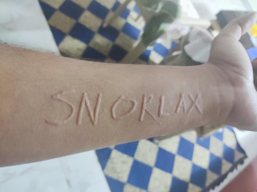 22 ejemplos en los que un mal funcionamiento de los genes dio a las personas un chip de apariencia único