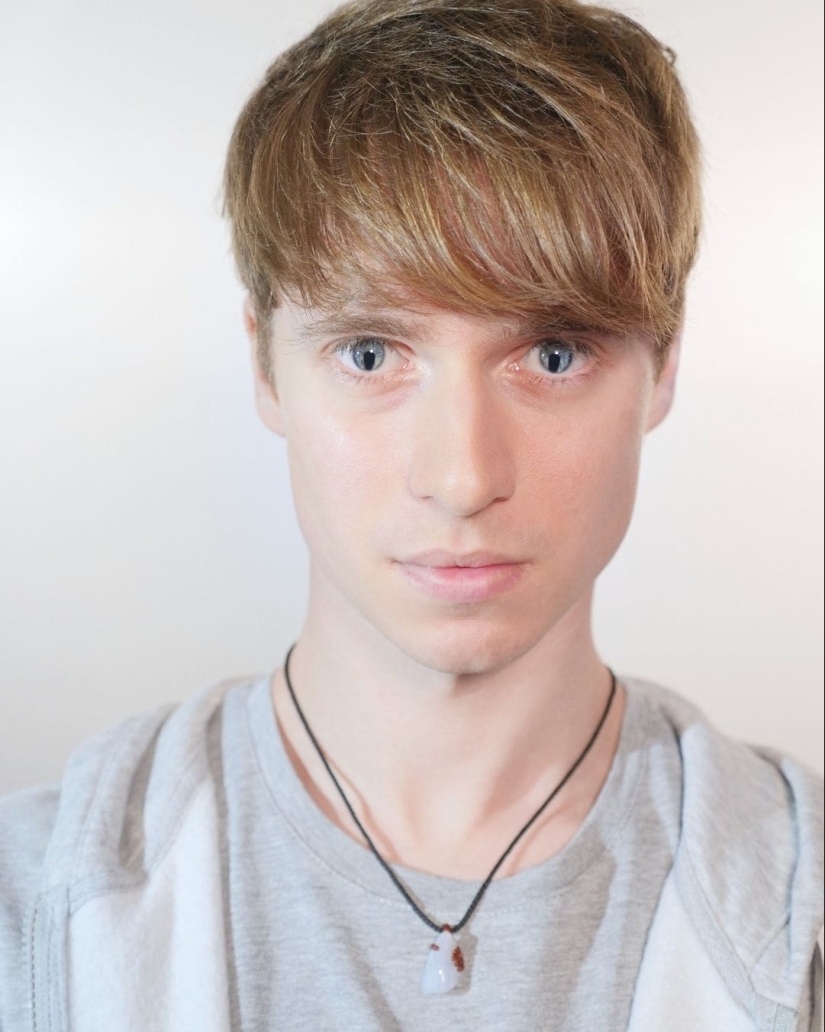 22 examples when a gene malfunction gave people a unique appearance chip 22 examples when a gene malfunction gave people a unique appearance chip