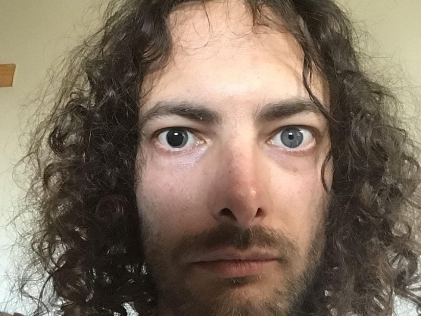 22 examples when a gene malfunction gave people a unique appearance chip 22 examples when a gene malfunction gave people a unique appearance chip