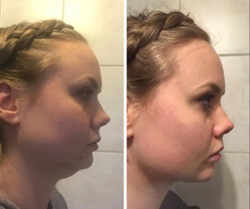 22 photos of people who went under the surgeon's knife and never regretted it 22 photos of people who went under the surgeon's knife and never regretted it