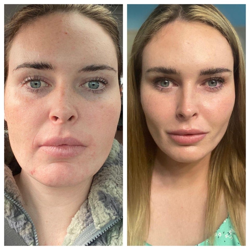 22 photos of people who went under the surgeon's knife and never regretted it 22 photos of people who went under the surgeon's knife and never regretted it