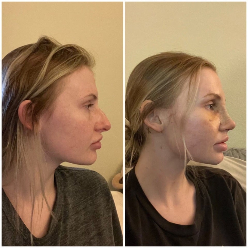 22 photos of people who went under the surgeon's knife and never regretted it 22 photos of people who went under the surgeon's knife and never regretted it