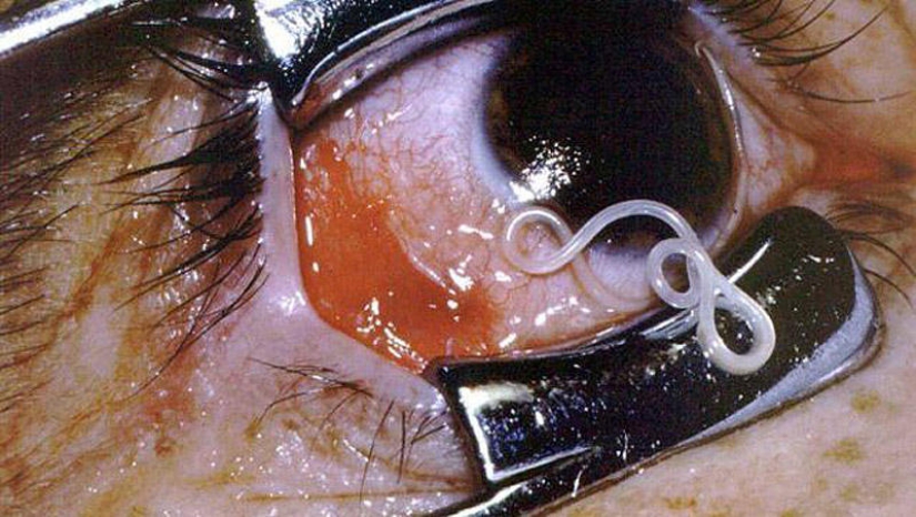 25 Most Unusual and Dangerous Parasites