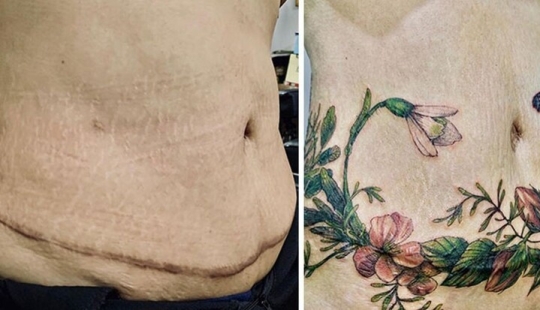 25 tattoos to cover scars and other defects on the body